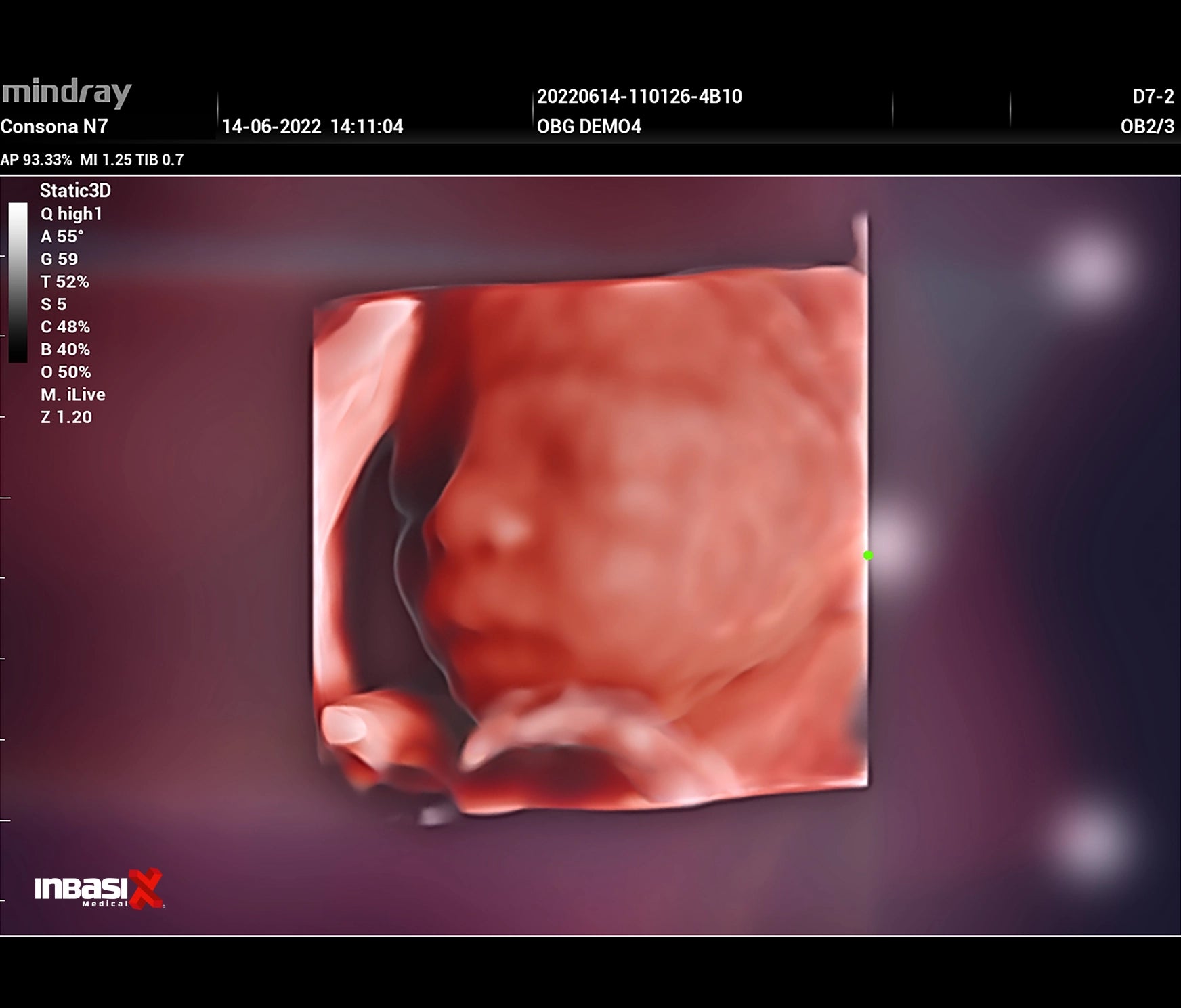 Ultrasonido Mindray CONSONA N7 incluye transductor Convexo + Lineal GINECOLOGÍA GABINETE HUMANO