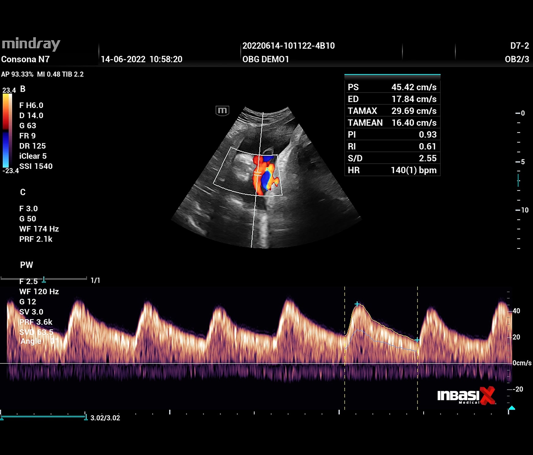 Ultrasonido Mindray CONSONA N7 incluye transductor Convexo + Lineal GINECOLOGÍA GABINETE HUMANO