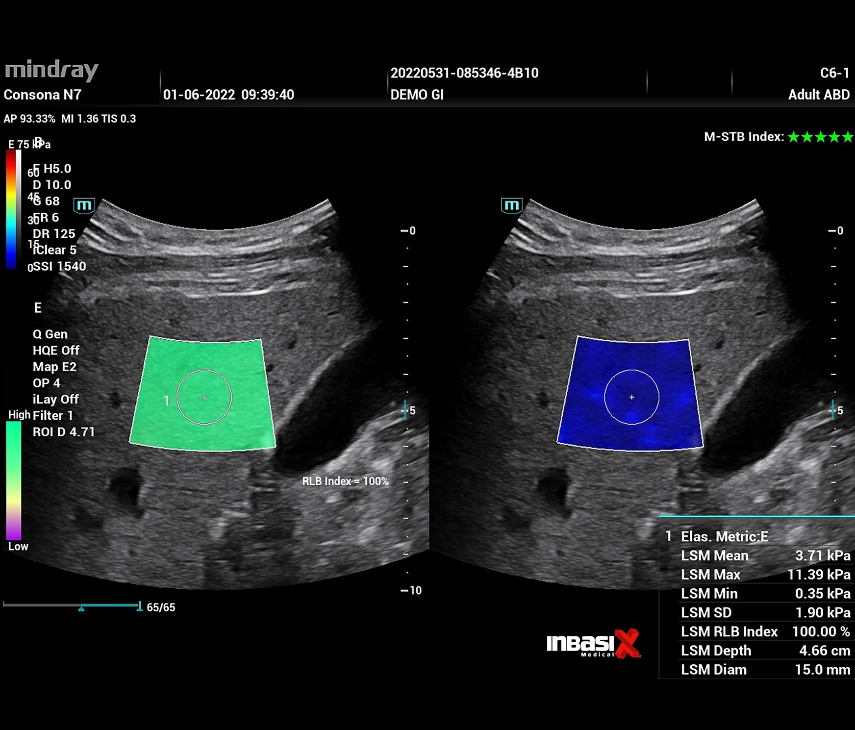 Ultrasonido Mindray CONSONA N7 incluye transductor Convexo + Lineal GINECOLOGÍA GABINETE HUMANO