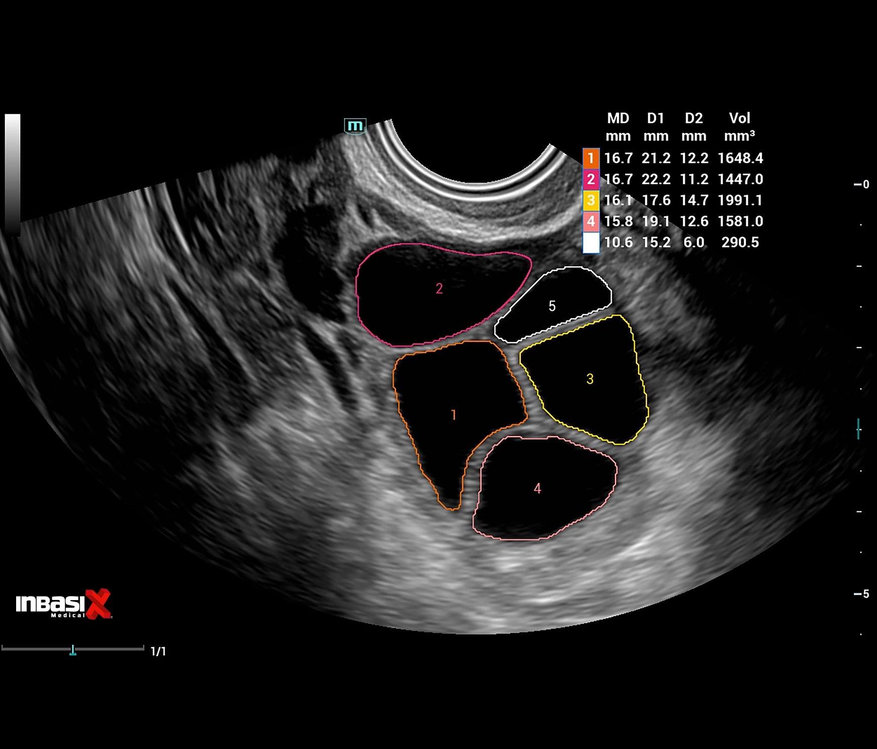 Ultrasonido Mindray CONSONA N9 incluye transductor Convexo + Lineal GINECOLOGÍA GABINETE HUMANO