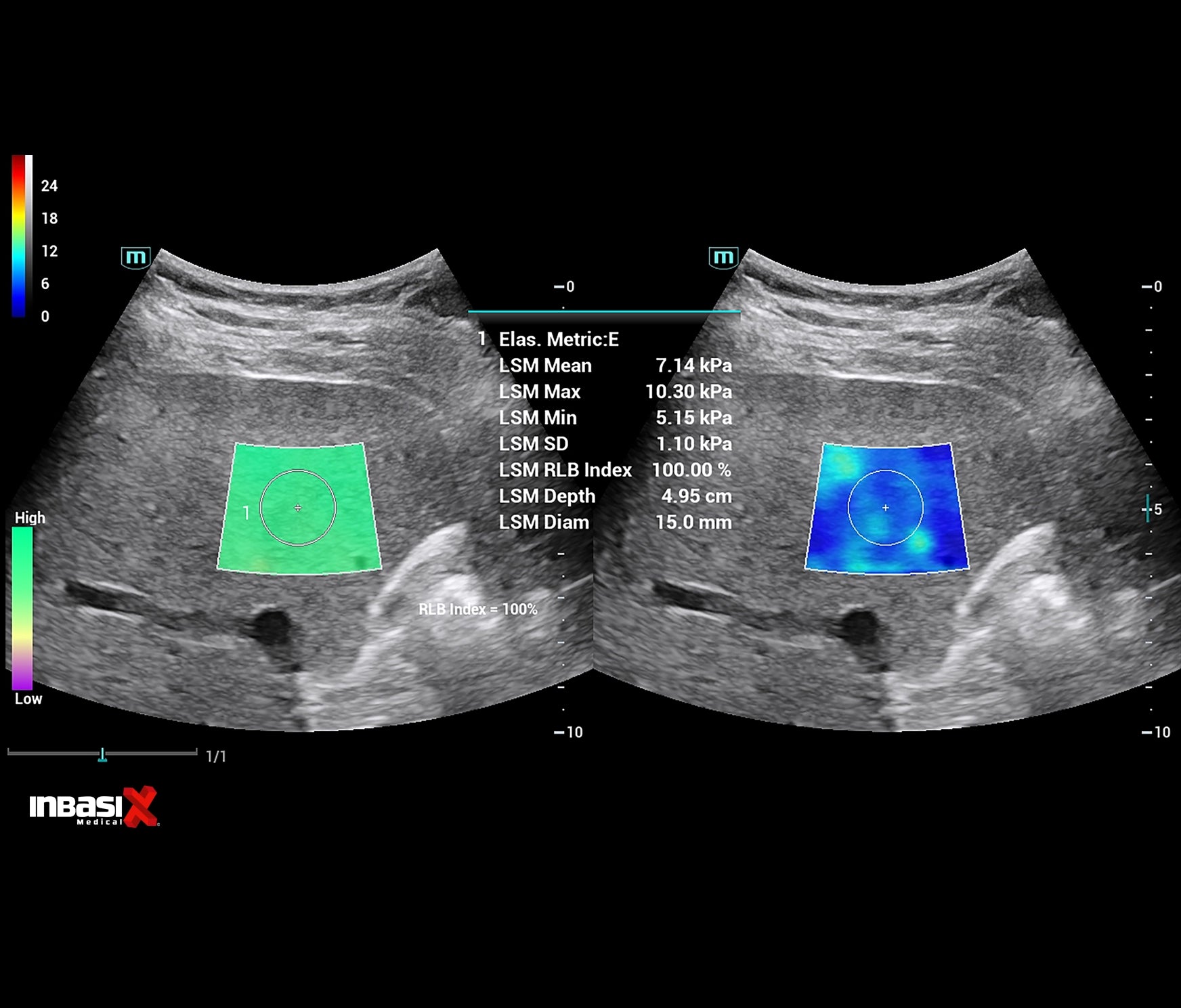 Ultrasonido Mindray CONSONA N9 incluye transductor Convexo + Lineal GINECOLOGÍA GABINETE HUMANO