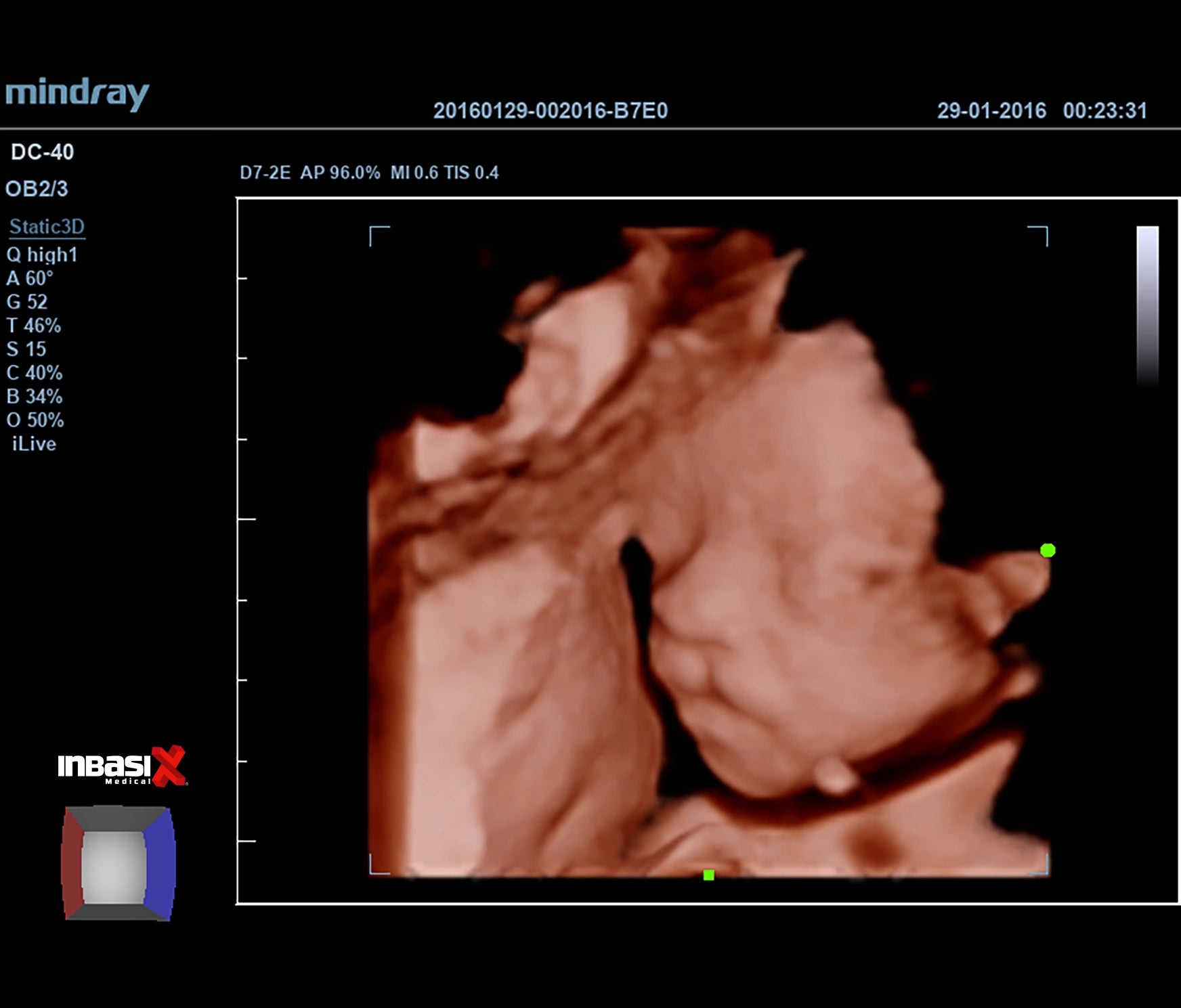 Ultrasonido Mindray DC40 FULL HD incluye transductor Volumétrico + Vaginal + Convexo GINECOLOGÍA