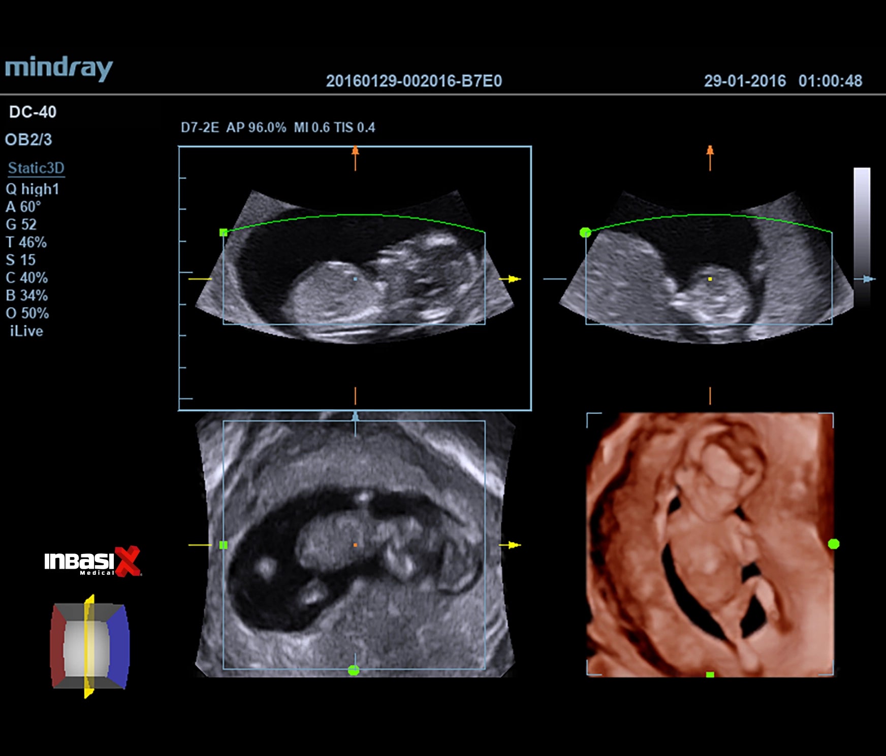 Ultrasonido Mindray DC40 FULL HD incluye transductor Volumétrico + Vaginal + Convexo GINECOLOGÍA