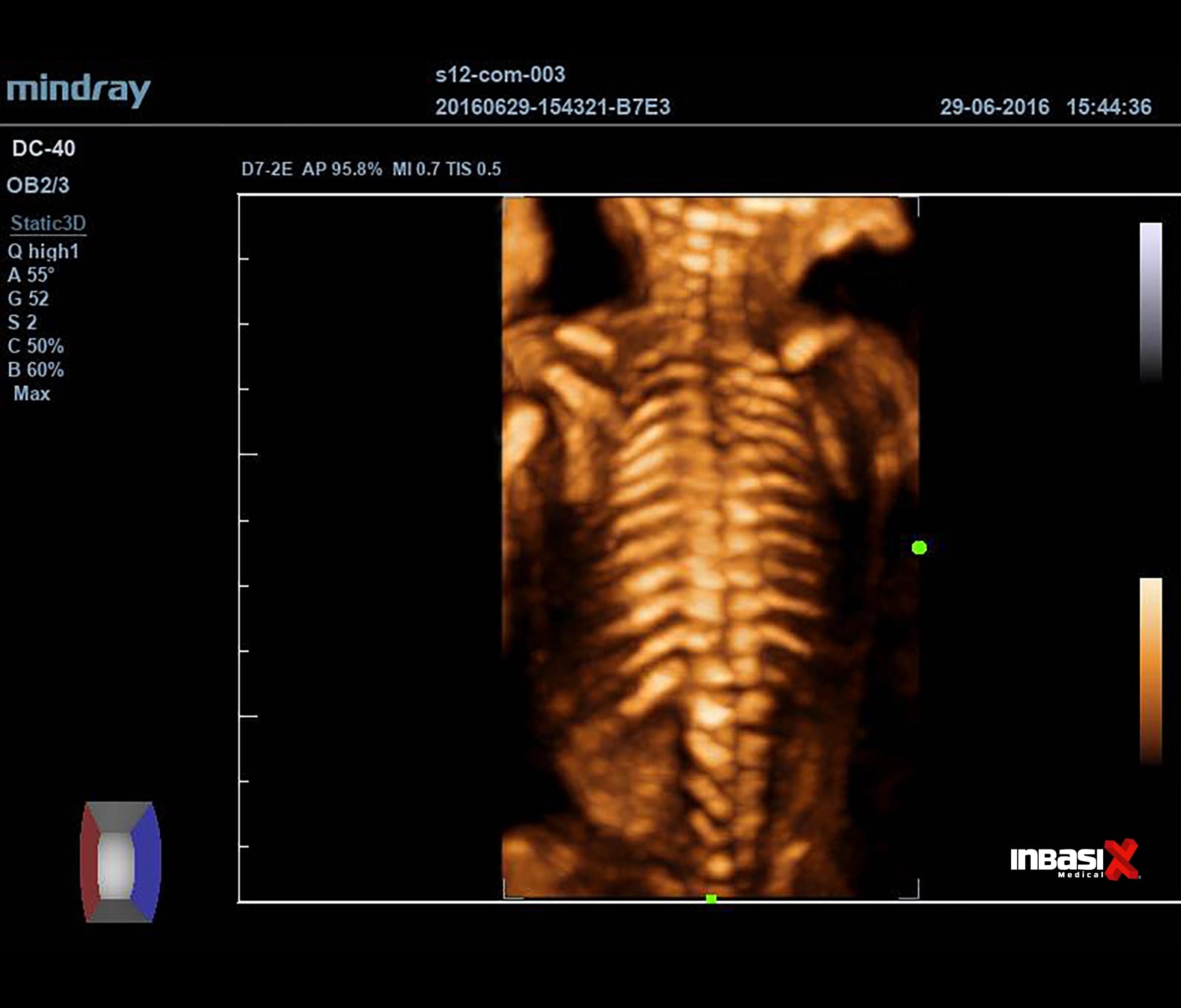 Ultrasonido Mindray DC40 FULL HD incluye transductor Volumétrico + Vaginal + Convexo GINECOLOGÍA
