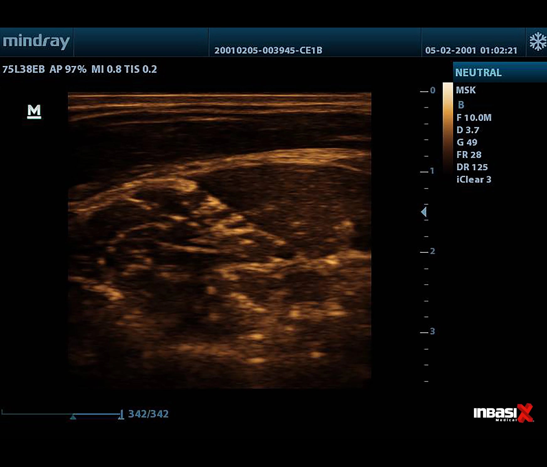 Ultrasonido Mindray DP20 Incluye Transductores Convexo + Lineal GINECOLOGÍA PORTÁTIL HUMANO