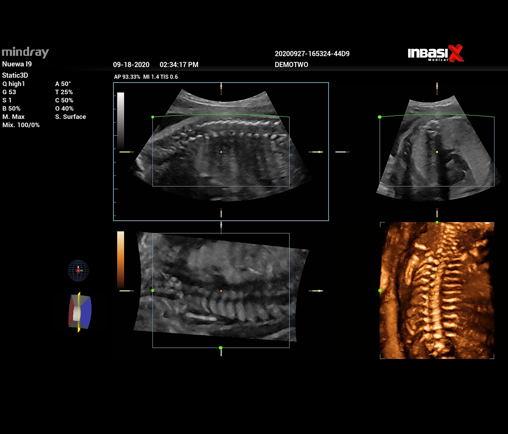 Ultrasonido Mindray NUEWA i9 incluye transductor convexo + endocavitario GINECOLOGÍA GABINETE HUMANO