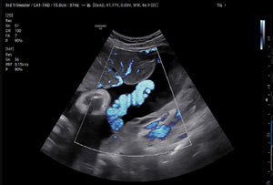 Cordón umbilical con MV-Flow™