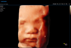 Cara del feto con RealisticVue™