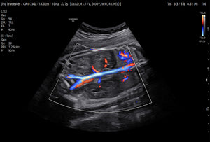 Arteria renal (S-Flow™ con LumiFlow™)
