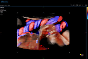 Cordón umbilical con CrystalVue Flow™