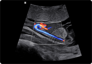 Arco aórtico fetal en 1er trimestre con S-Flow  