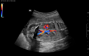 Arteria renal fetal - Color
