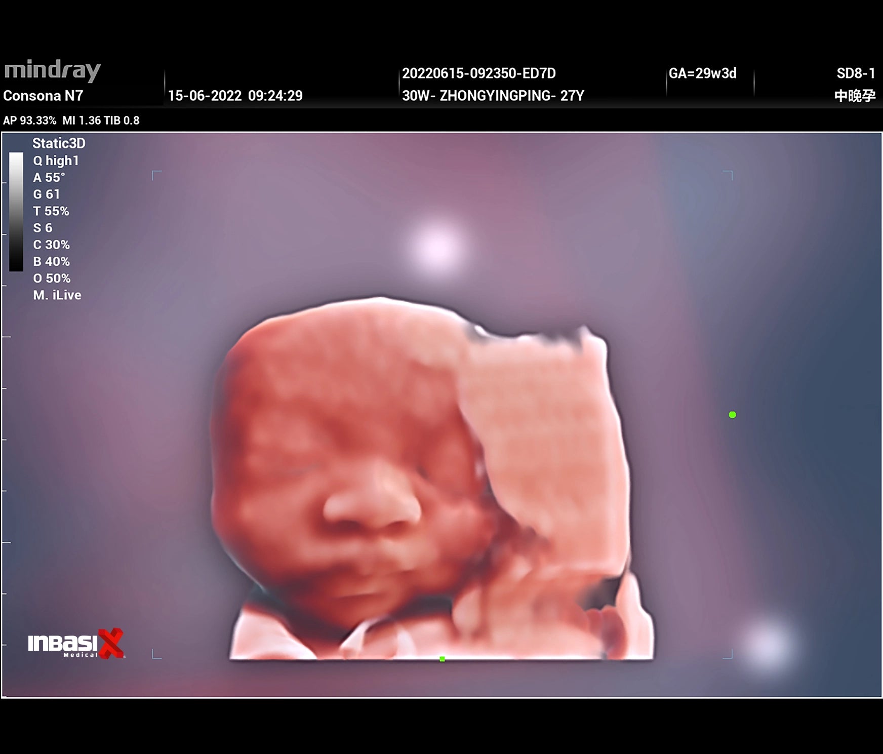 Ultrasonido Mindray CONSONA N7 incluye transductor Convexo + Lineal GINECOLOGÍA GABINETE HUMANO