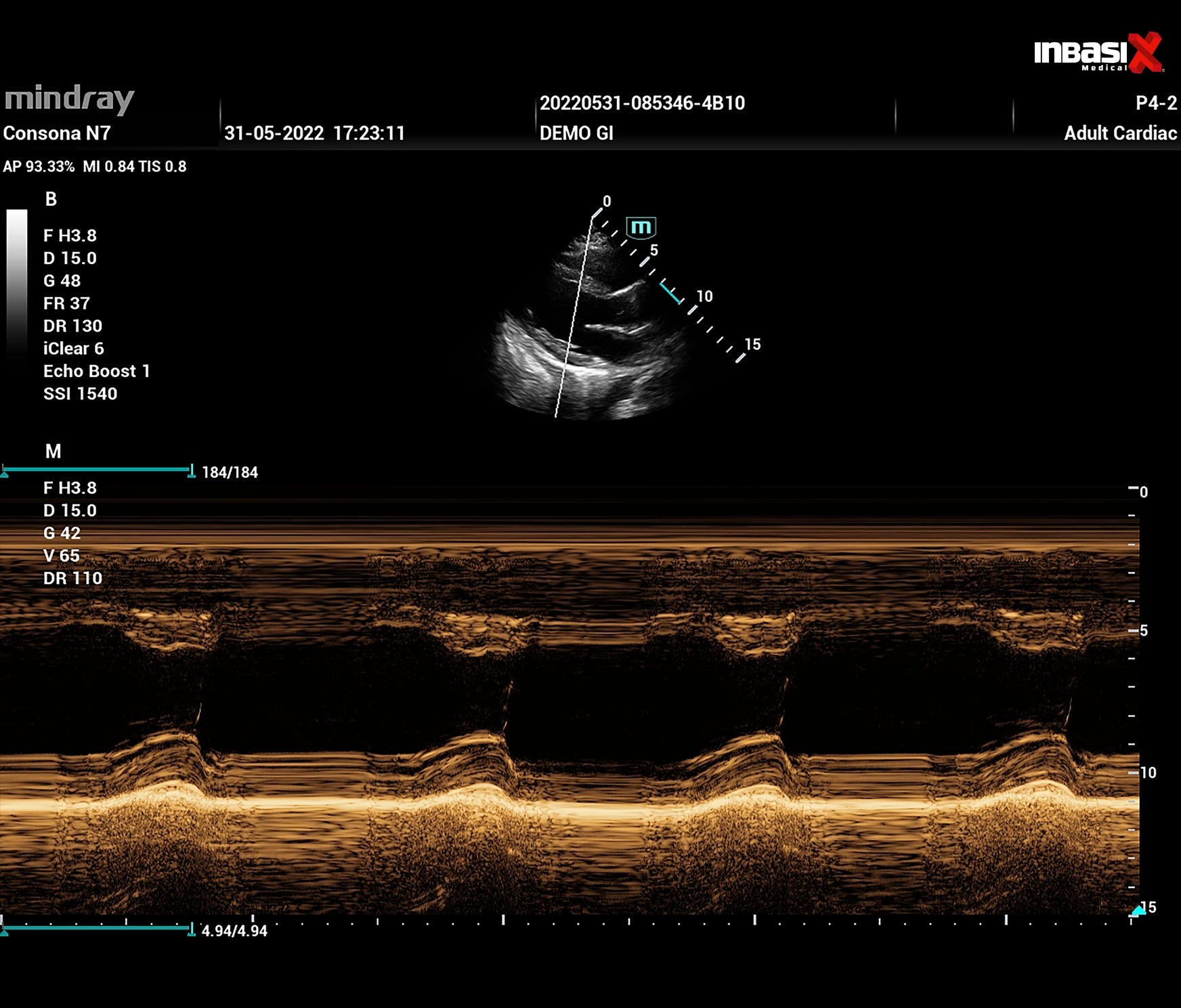 Ultrasonido Mindray CONSONA N7 incluye transductor Convexo + Lineal GINECOLOGÍA GABINETE HUMANO