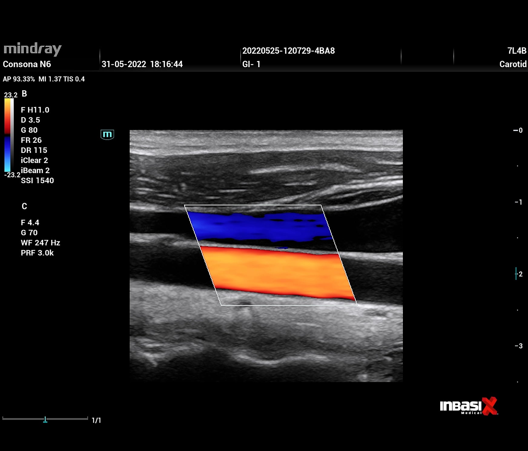 Ultrasonido Mindray CONSONA N7 incluye transductor Convexo + Lineal GINECOLOGÍA GABINETE HUMANO