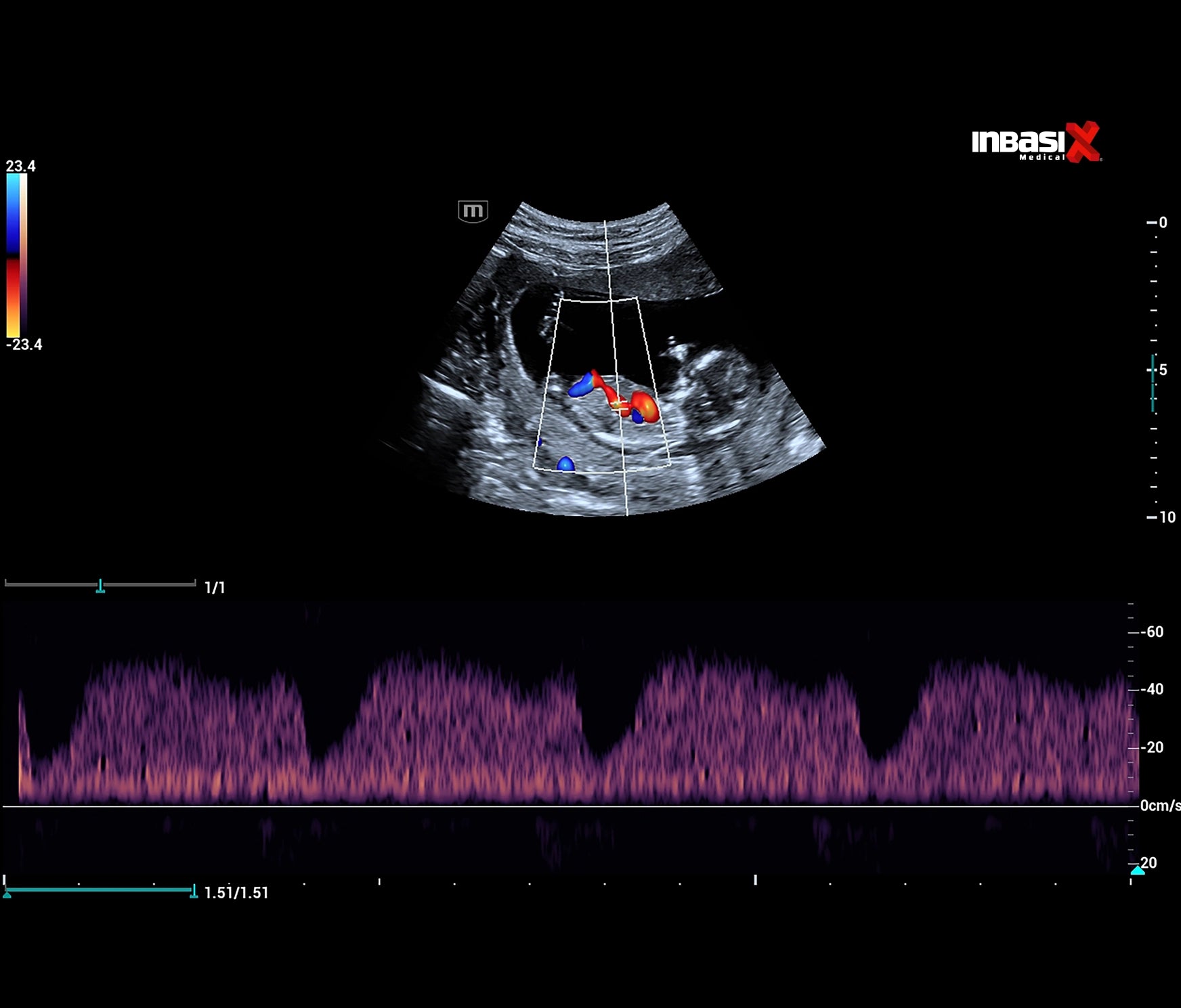 Ultrasonido Mindray CONSONA N9 incluye transductor Convexo + Lineal GINECOLOGÍA GABINETE HUMANO