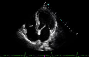 Cardiac 4CH
