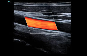 Carotid CDI
