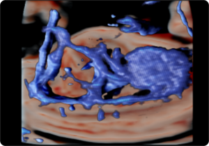 Circulación fetal con MV Flow en 3D  