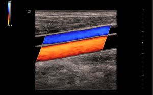 Carotid Color