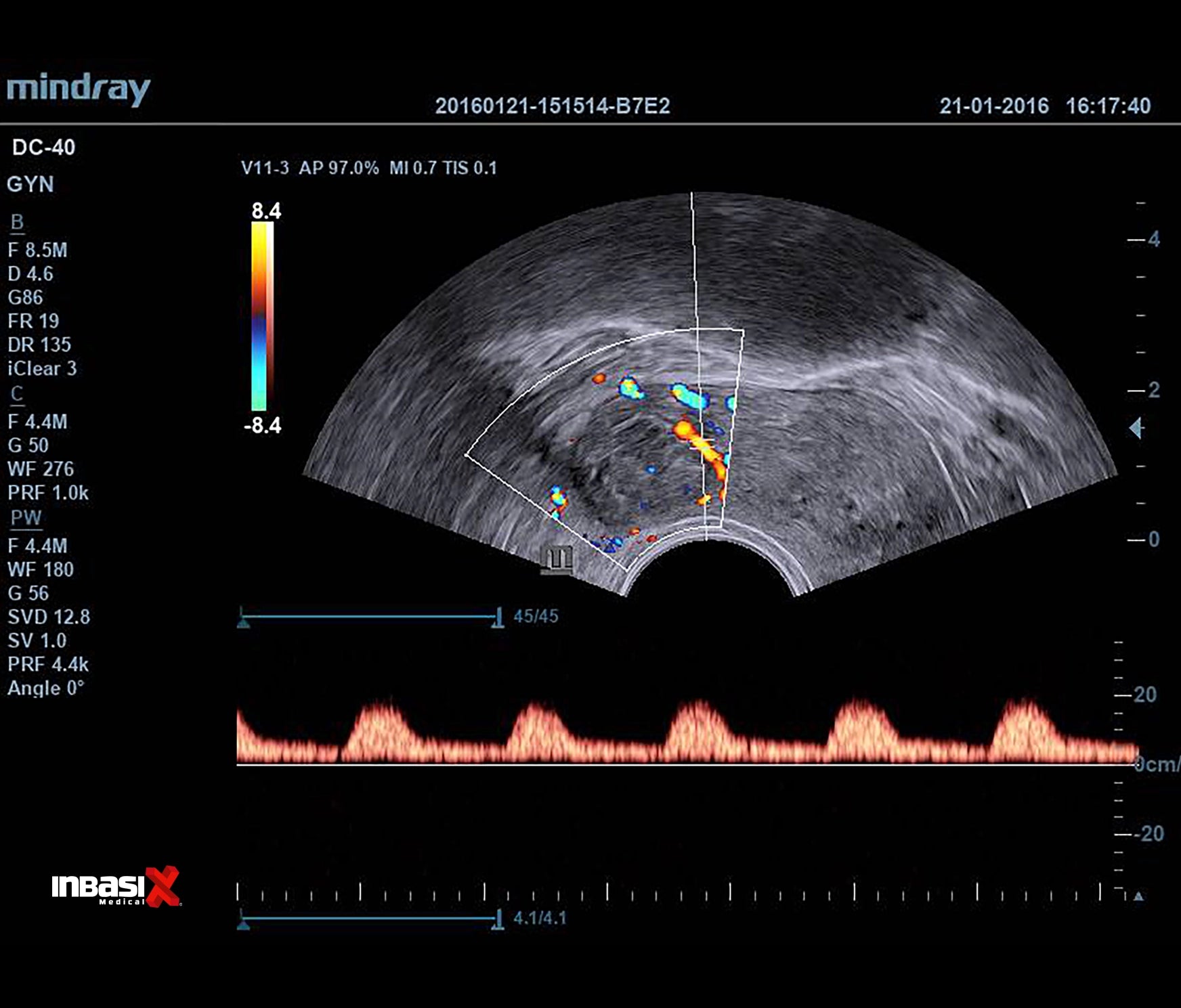 Ultrasonido Mindray DC40 FULL HD incluye transductor Volumétrico + Vaginal + Convexo GINECOLOGÍA