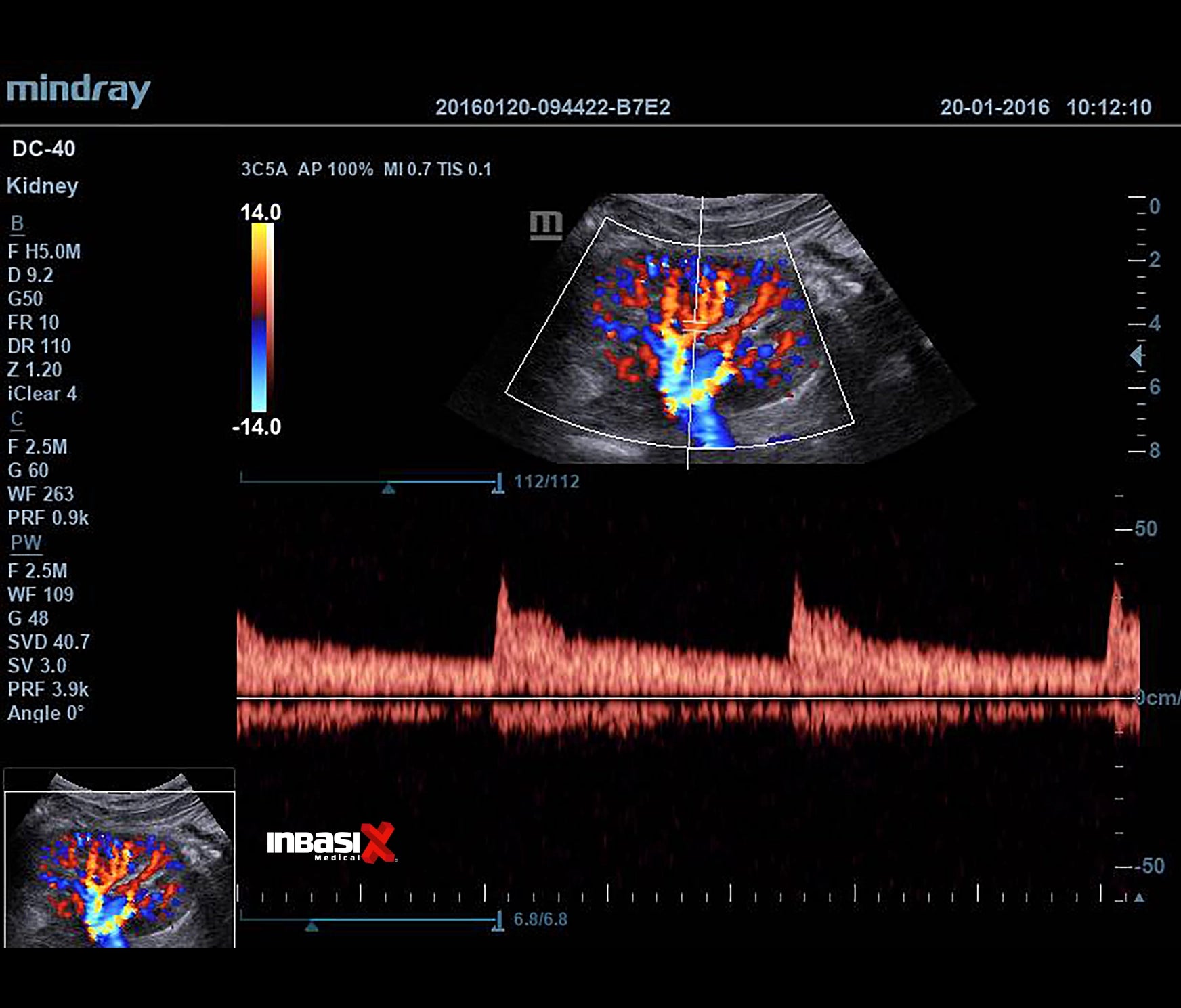 Ultrasonido Mindray DC40 FULL HD incluye transductor Volumétrico + Vaginal + Convexo GINECOLOGÍA