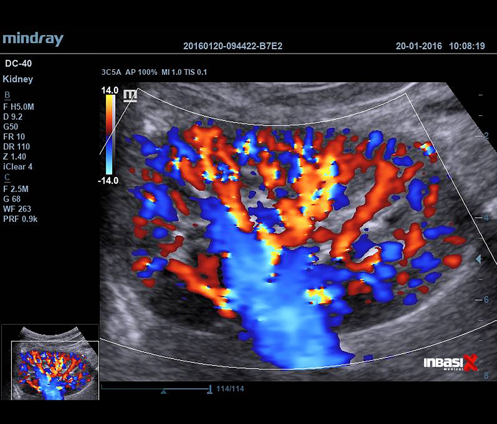 Ultrasonido Mindray DC40 FULL HD incluye transductor Volumétrico + Vaginal + Convexo GINECOLOGÍA