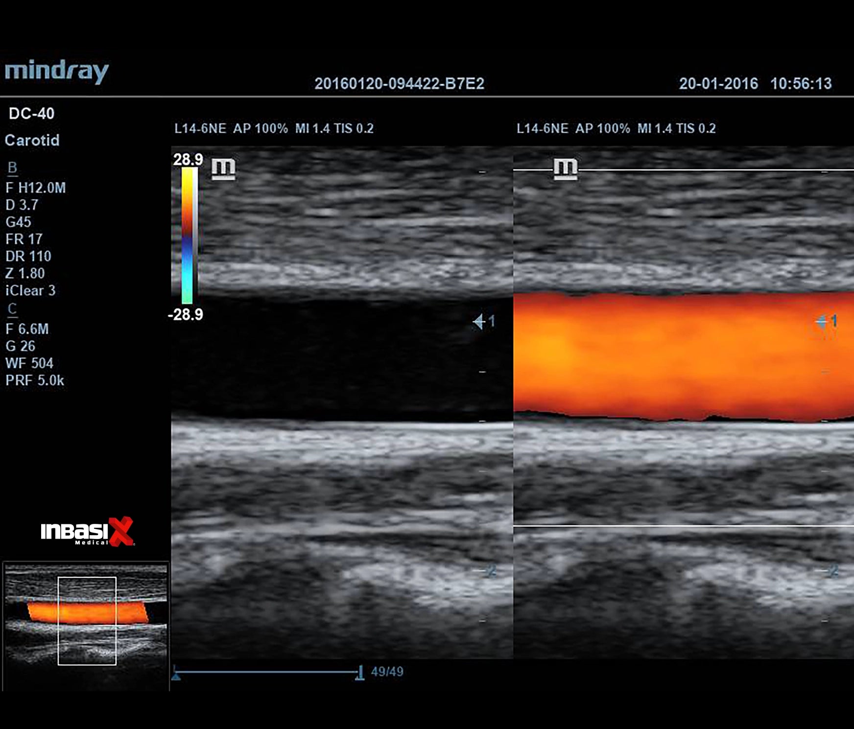 Ultrasonido Mindray DC40 FULL HD incluye transductor Volumétrico + Vaginal + Convexo GINECOLOGÍA