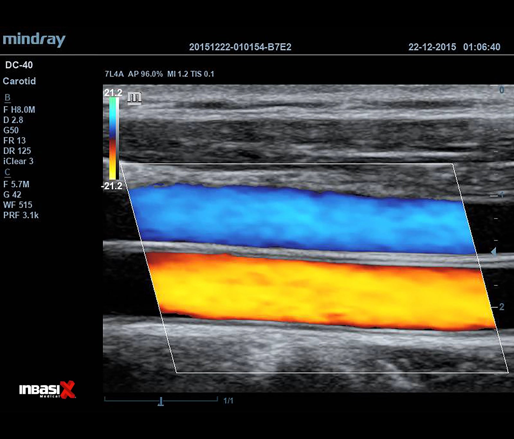 Ultrasonido Mindray DC40 FULL HD incluye transductor Volumétrico + Vaginal + Convexo GINECOLOGÍA
