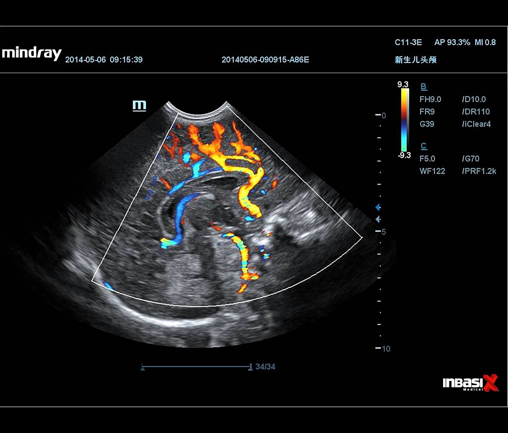 Ultrasonido Mindray DP20 Incluye Transductores Convexo + Lineal GINECOLOGÍA PORTÁTIL HUMANO