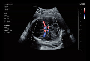 Cerebro fetal usando S-Flow™