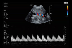 Cordón Umbilical usando PW