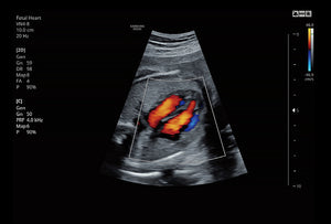 Corazón fetal usando Color
