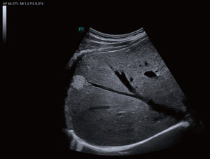 Hemangioma hepático