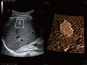 Hemangioma hepático | HD Scope ⁺