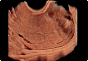 Mioma uterino con CrystalVue