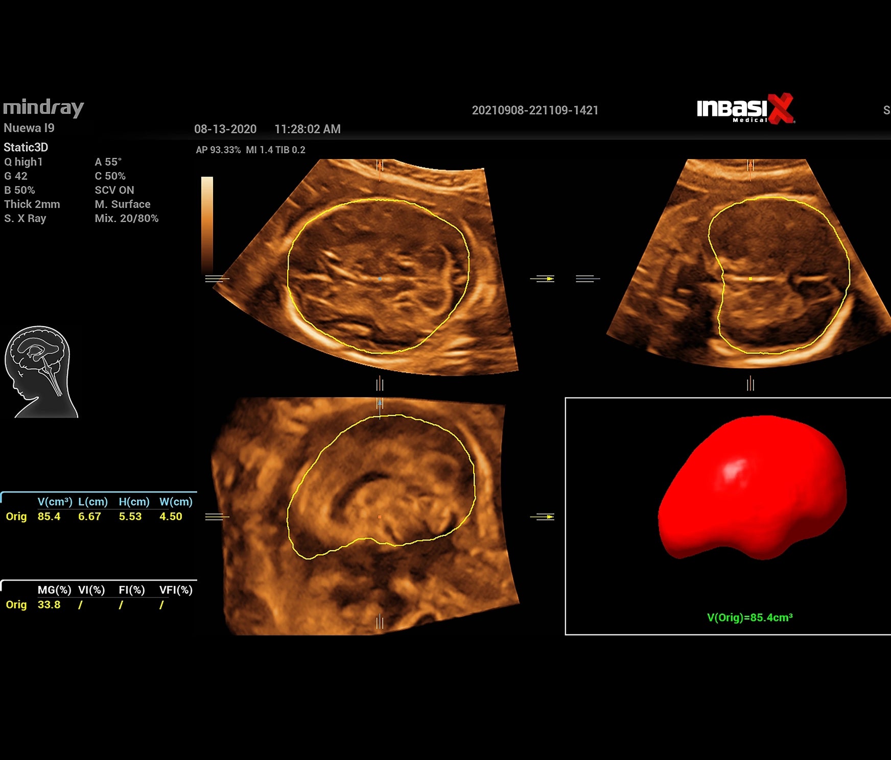 Ultrasonido Mindray NUEWA i9 incluye transductor convexo + endocavitario GINECOLOGÍA GABINETE HUMANO