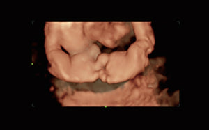 Pie en varo fetal