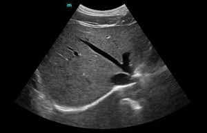 Porta Hepatis