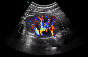 Renal CDI