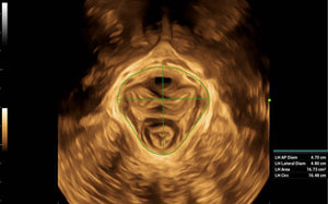 Pelvis inteligente-3D