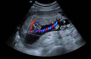 Umbilical Cord Flow