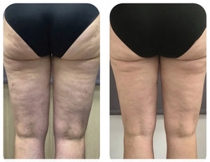 Tratamiento de celulitis