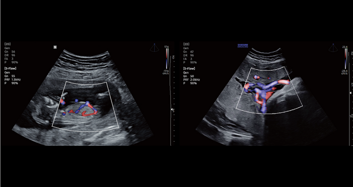 Doppler de potencia direccional para examinar los vasos periféricos