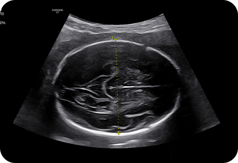 Una medición de biometría fetal automática