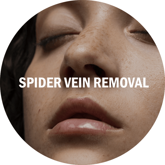 Tecnología de Vanguardia para la Eliminación de Venas en Araña