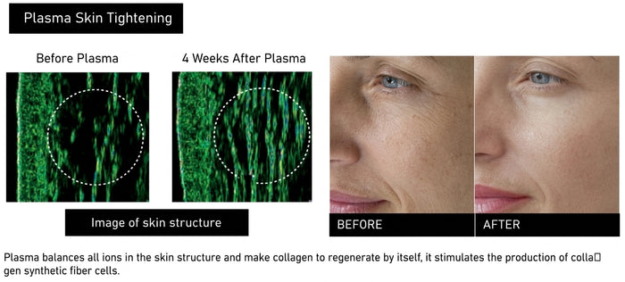 Tensado de piel con plasma