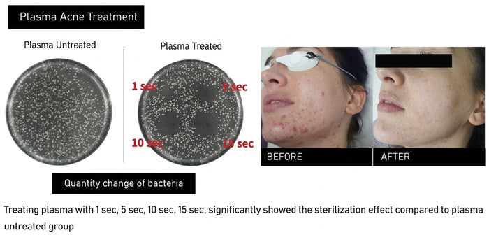 Tratamiento del acné con plasma